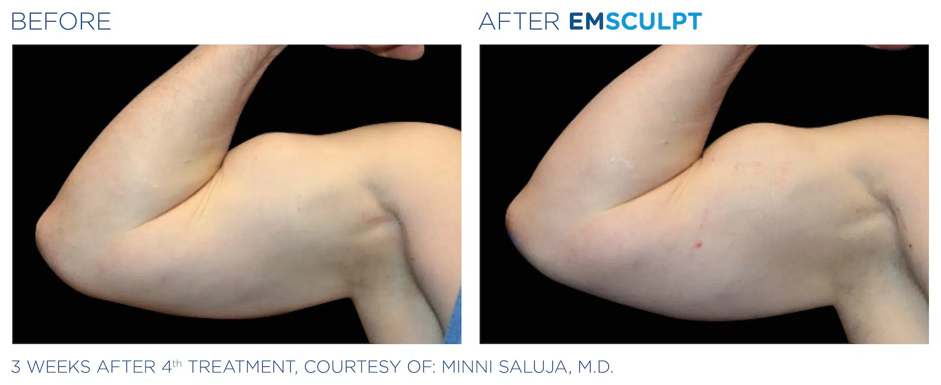 Emsculpt before and after to arm area.
