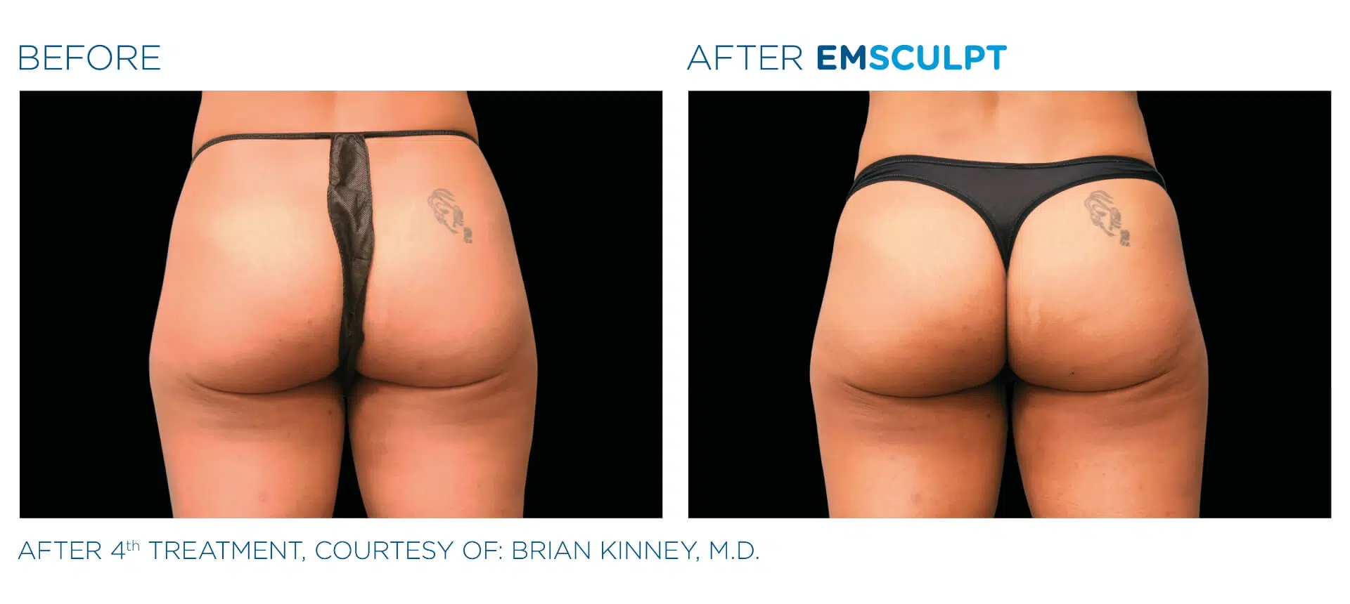 Bmsculpt booty before & after four treatments.