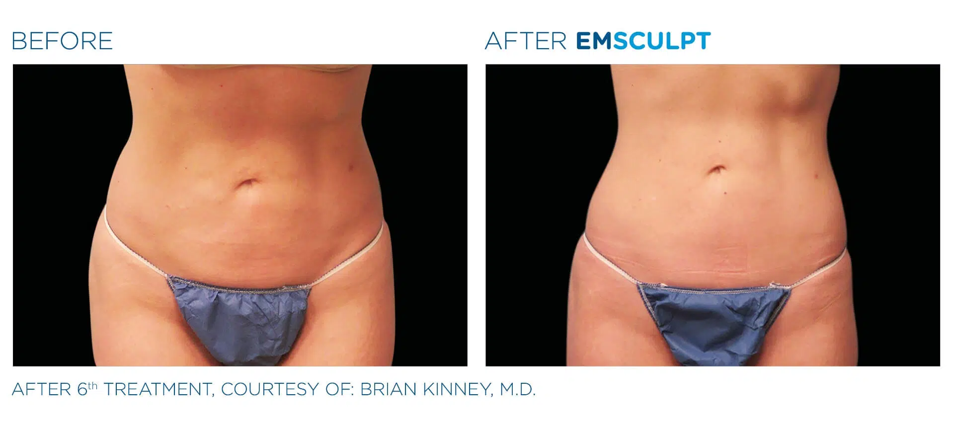 Emsculpt abdominal are before and after results.