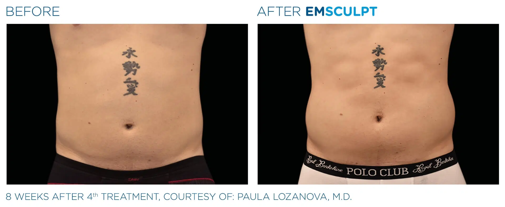 Emsculpt abdomen before and after results.