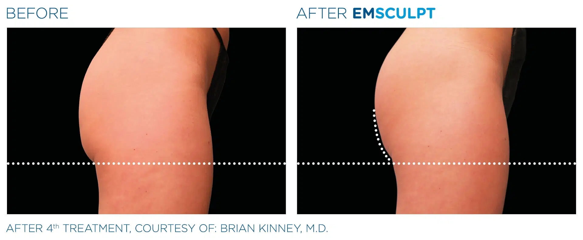 Emsculpt booty before & after results.