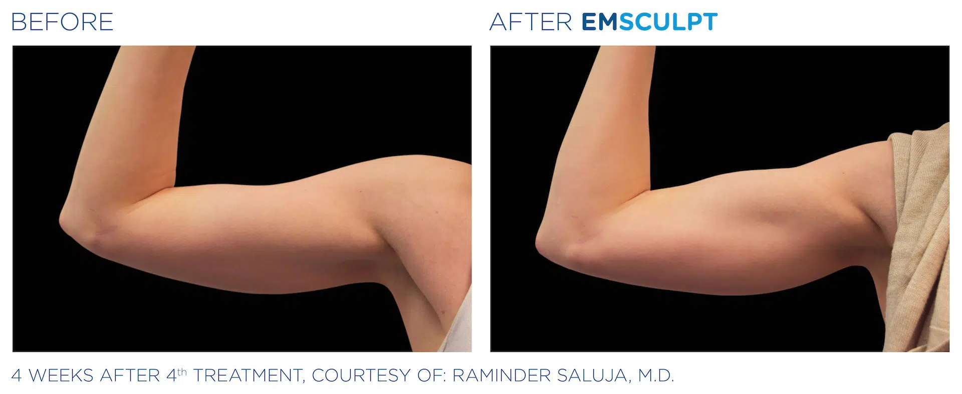 emsculpt yonkers before after
