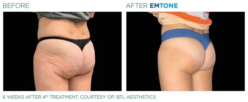 cellulite treatment before and after