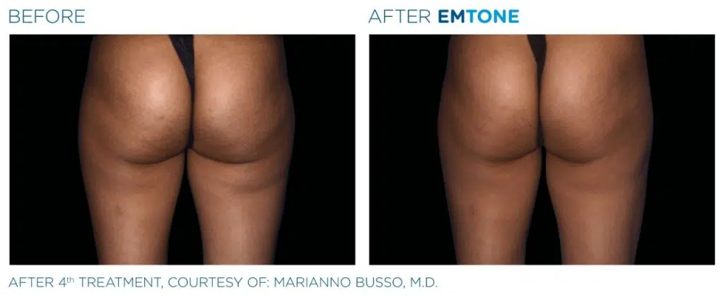 cellulite treatment before and after