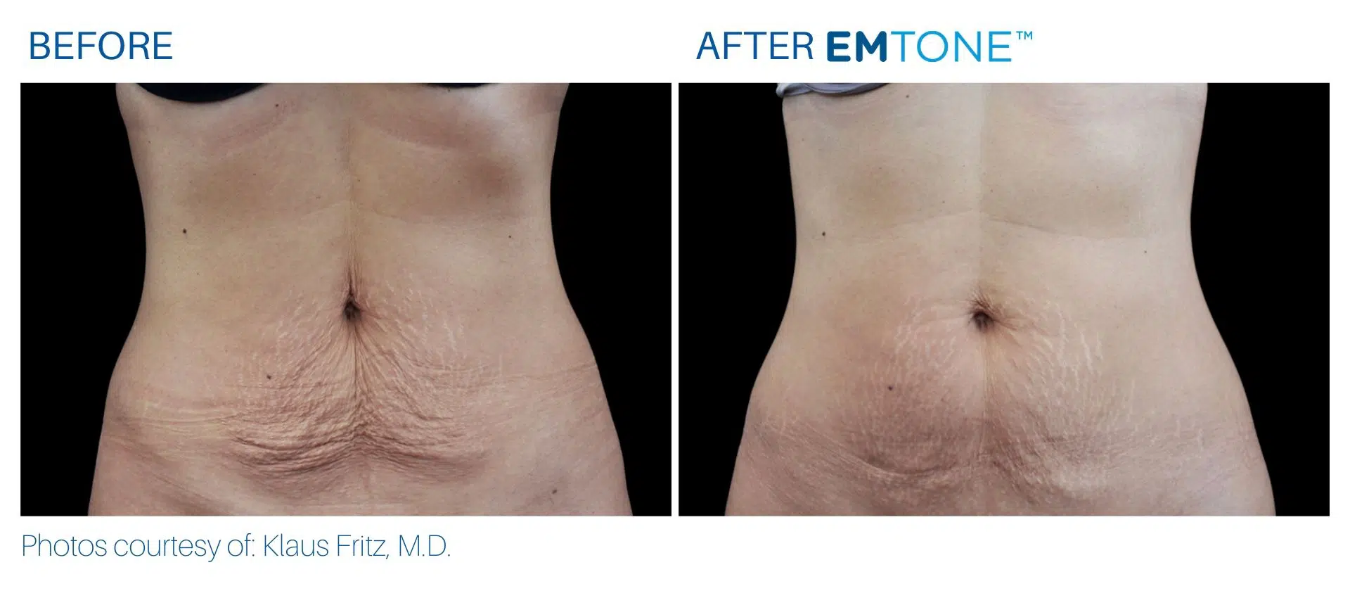 emtone cellulite treatment abdomen before and after at BodyMorphMD
