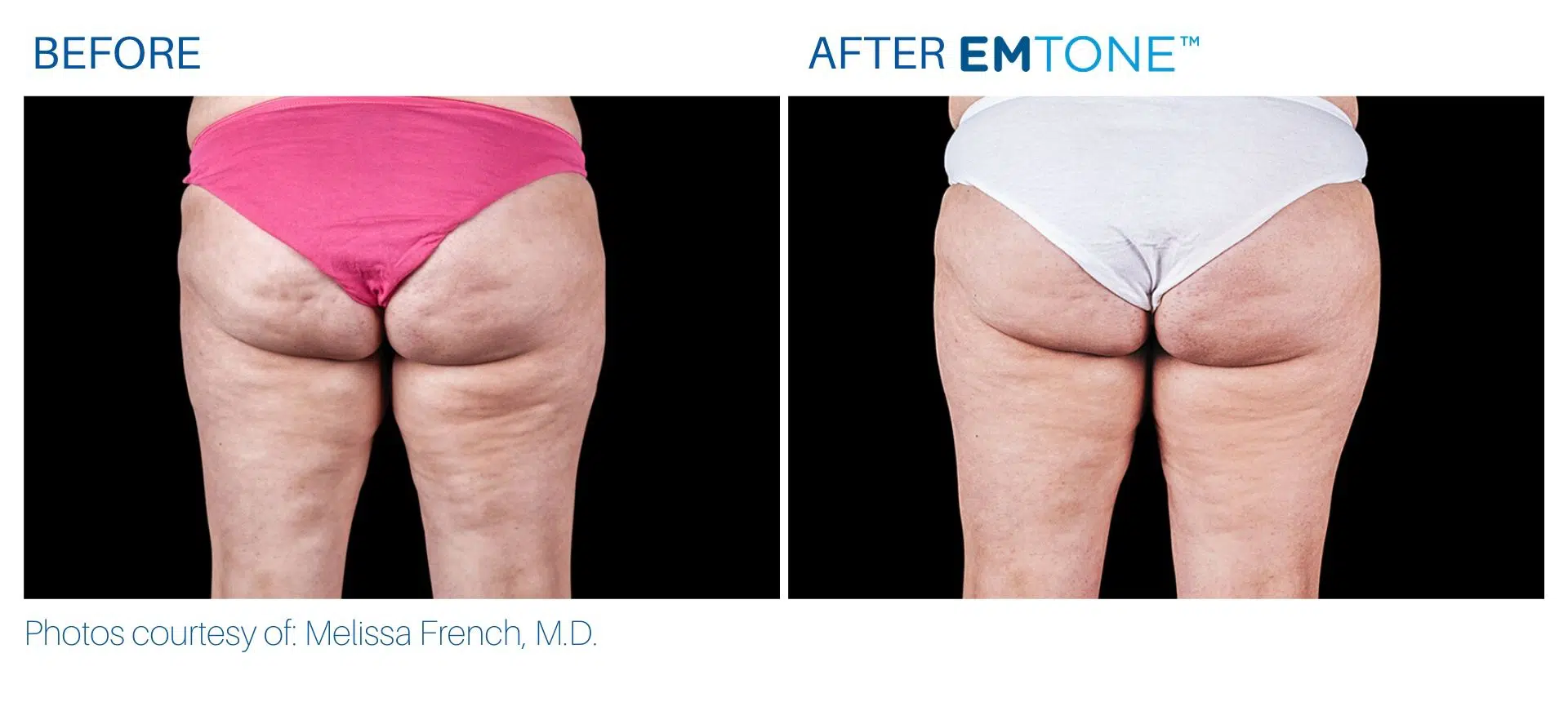 emtone cellulite treatment buttocks before and after at BodyMorphMD in Yonkers, NY