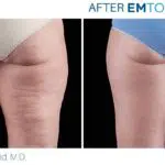 EMTONE BEFORE AND AFTER