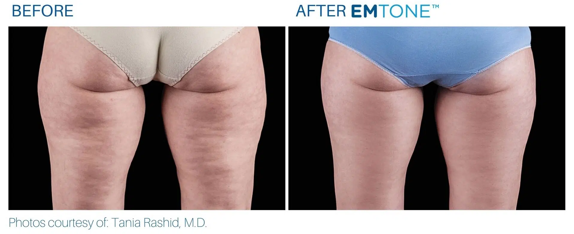 EMTONE BEFORE AND AFTER