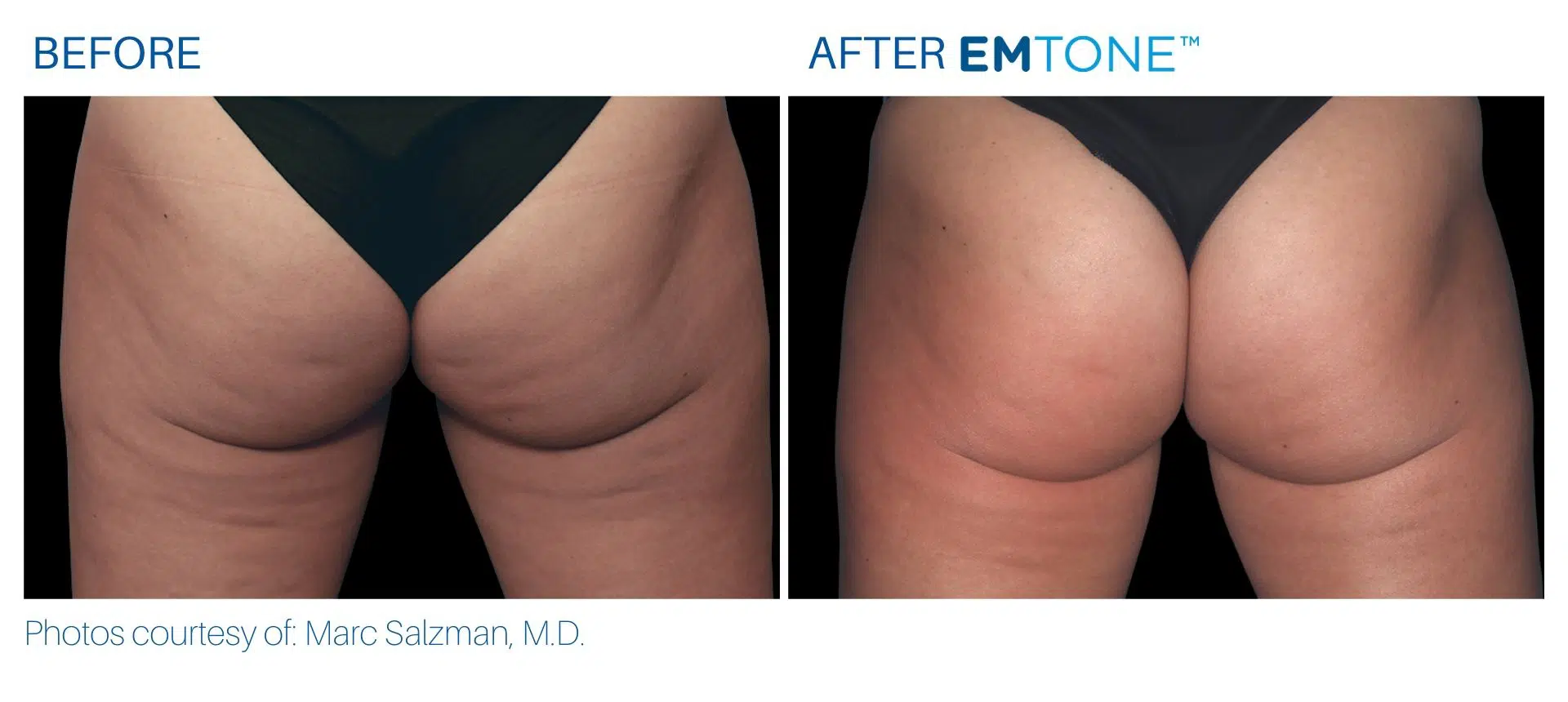Emtone buttocks before and after result BodyMorphMD.