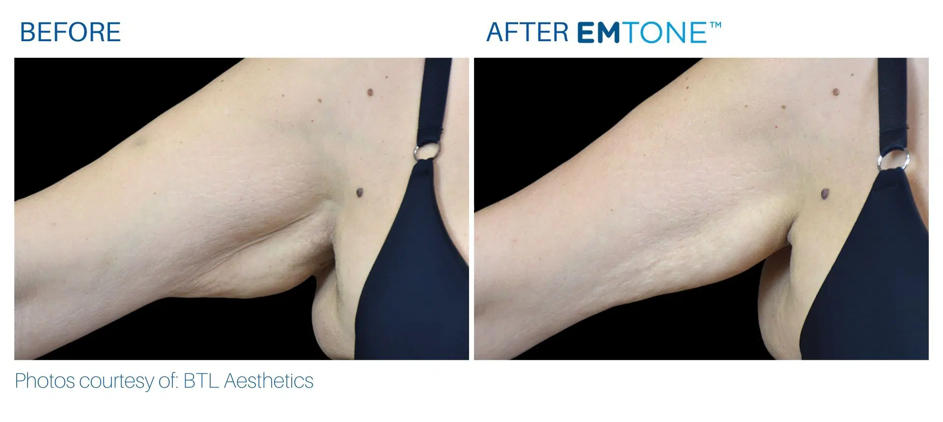 Emtone arms before and after result BodyMorphMD.