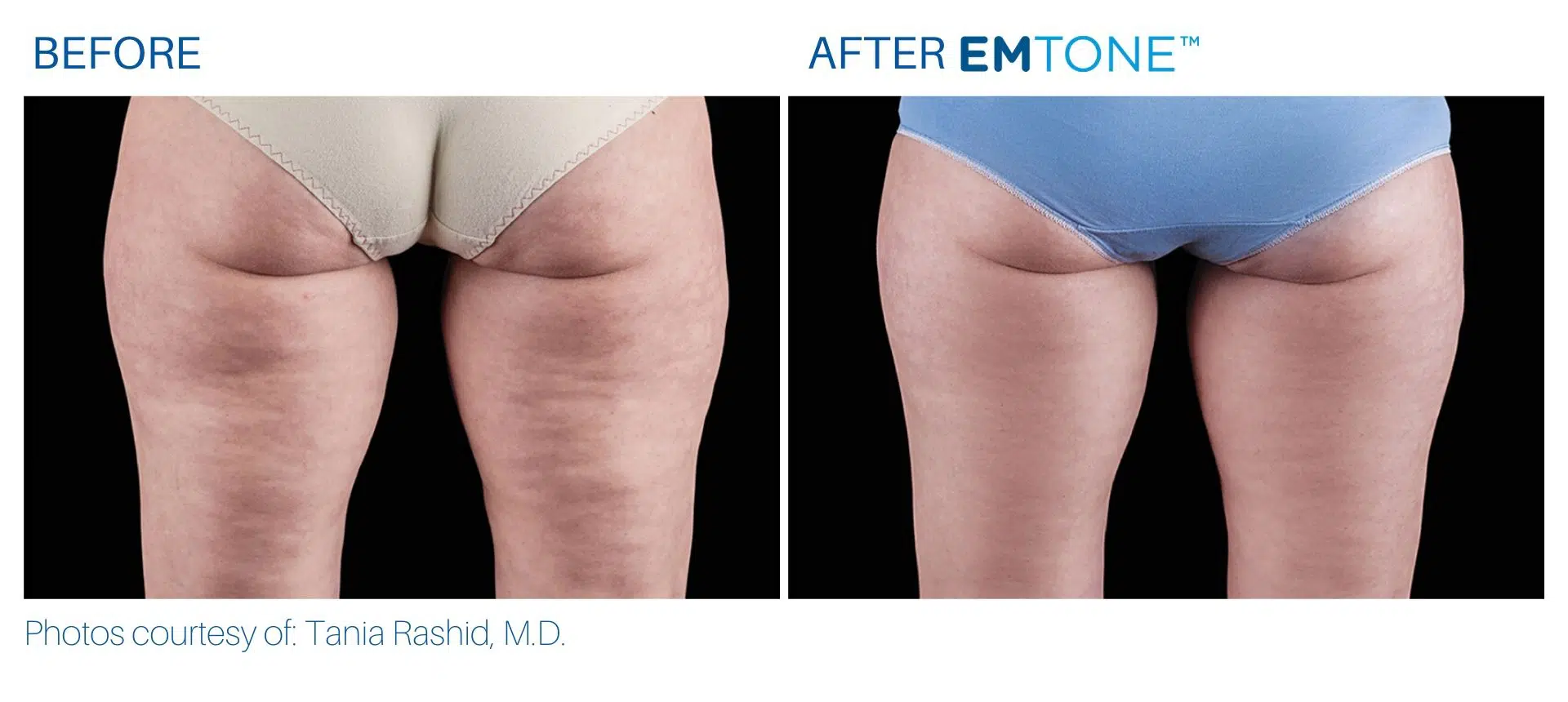 Emtone before and after result thighs BodyMorphMD