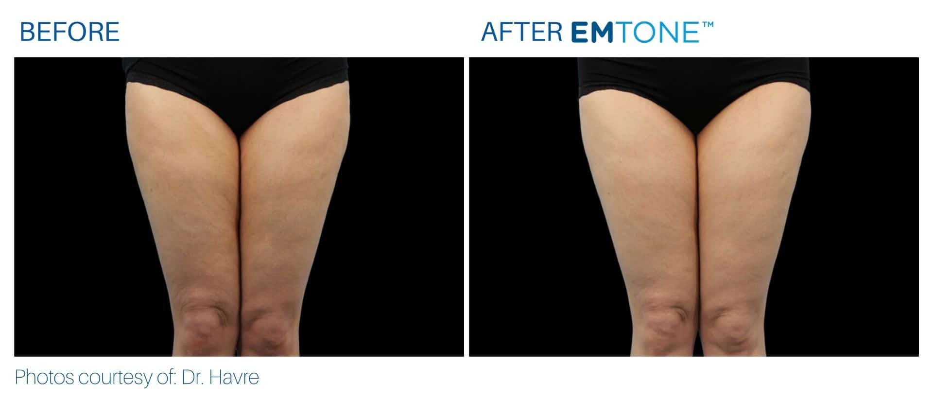 Emtone thighs before and after result Yonkers, NY.
