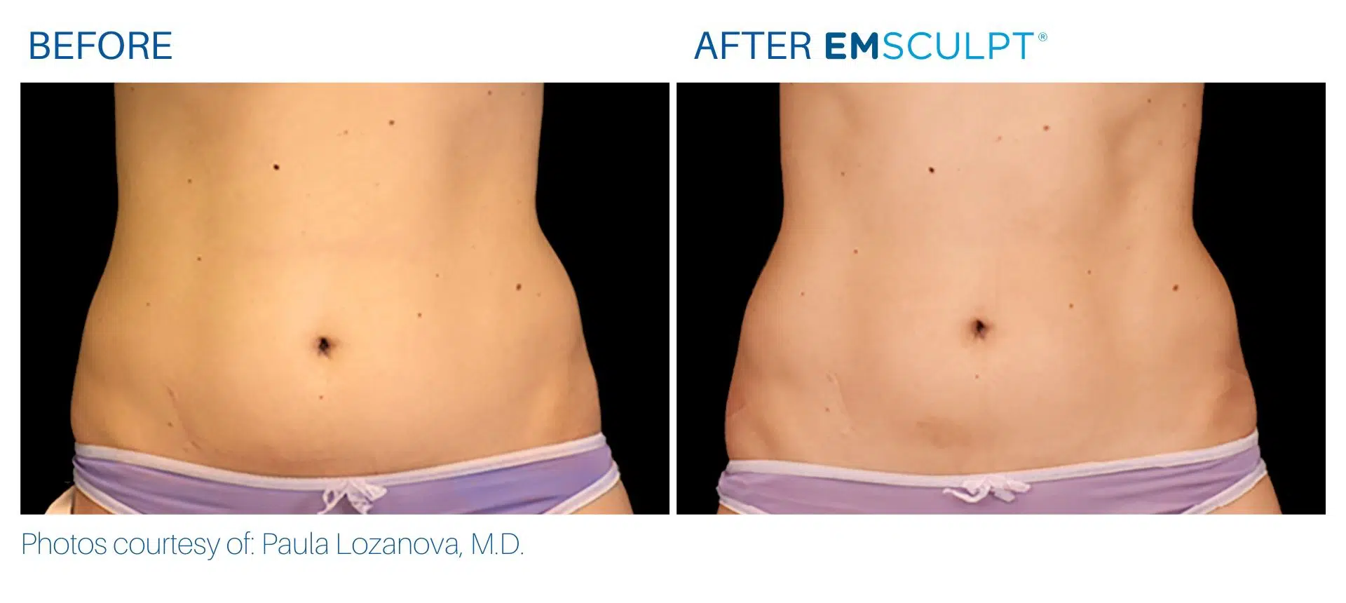 Emsculpt before and after transformations after treatment