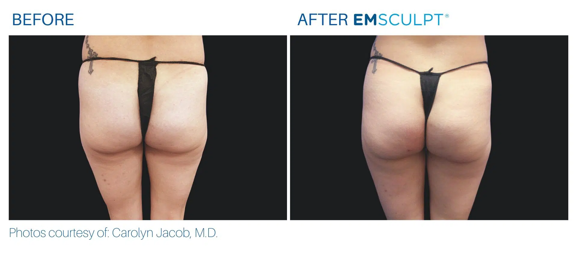 Emsculpt before and after butt lift treatment Body Morph MD