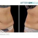 Emsculpt before and after abdomen treatment Body Morph MD