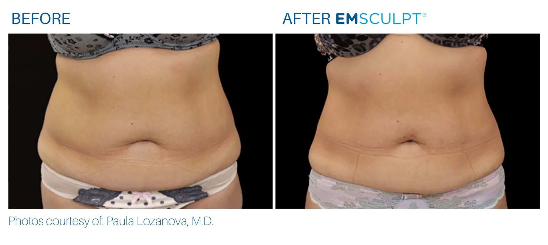 Emsculpt before and after abdomen treatment Body Morph MD