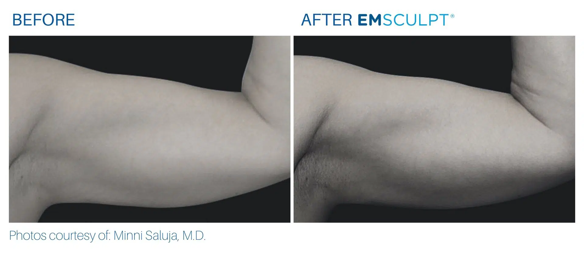 Emsculpt transformations from real-life patients Body Morph MD