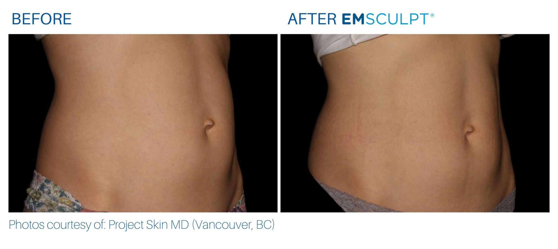 Emsculpt before and after results Body Morph MD