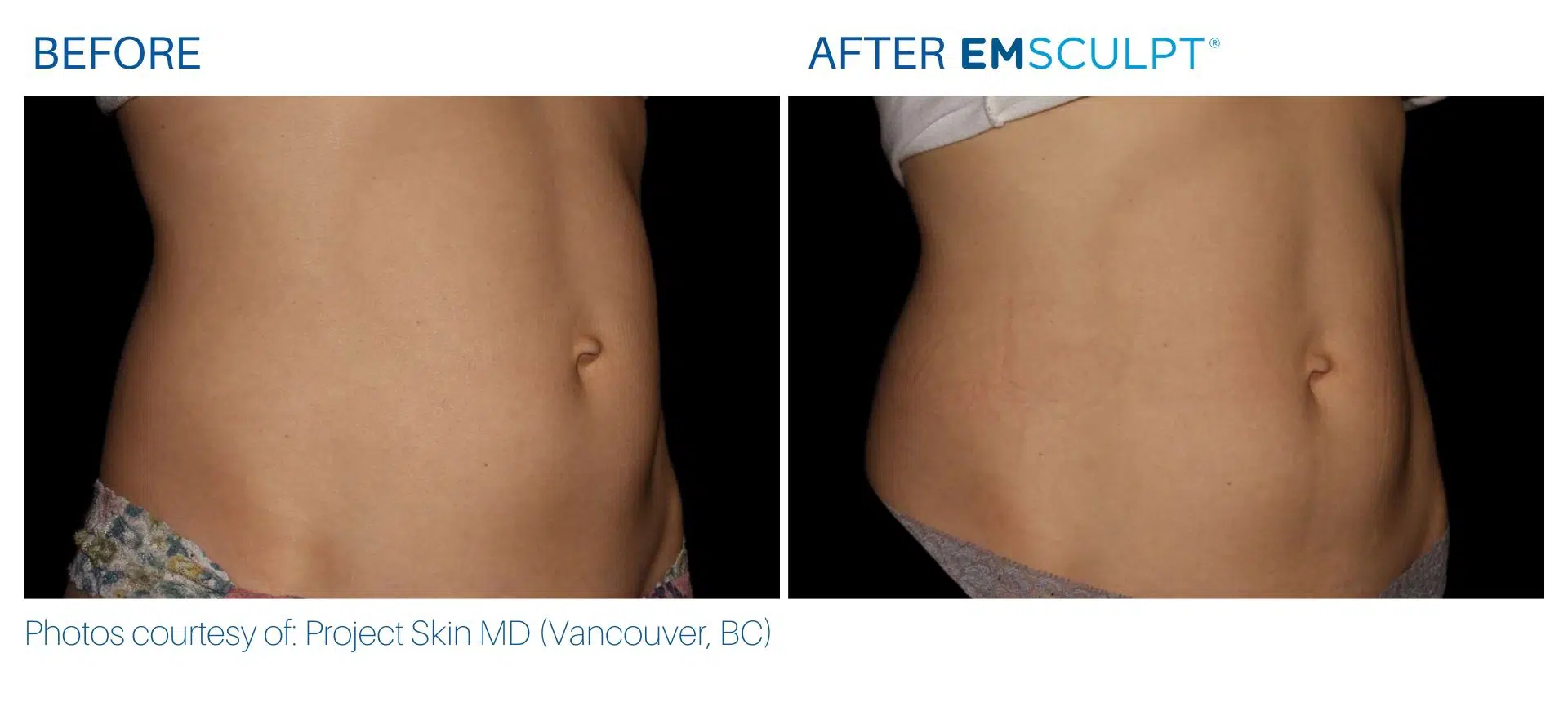 Emsculpt before and after results Body Morph MD