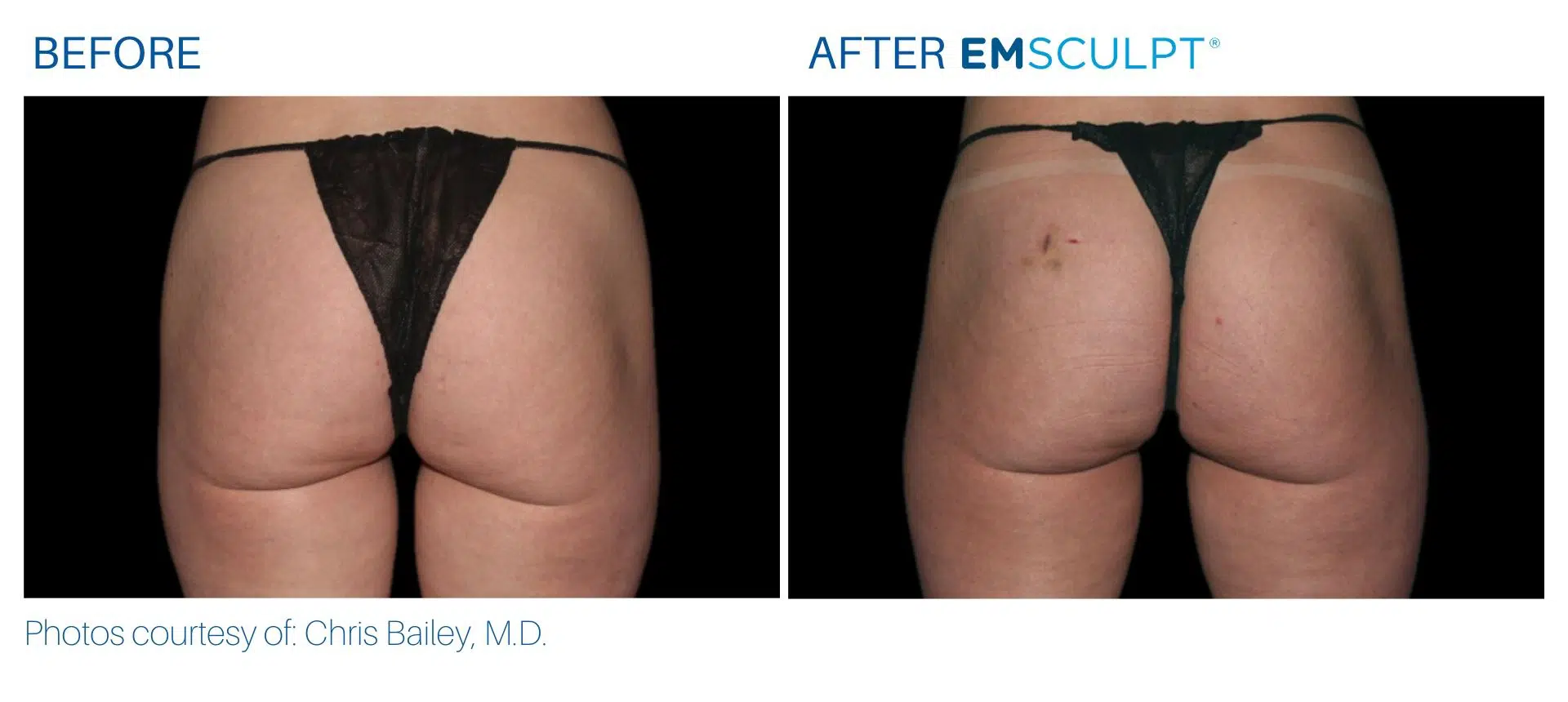 Emsculpt real patient results in Body Morph MD