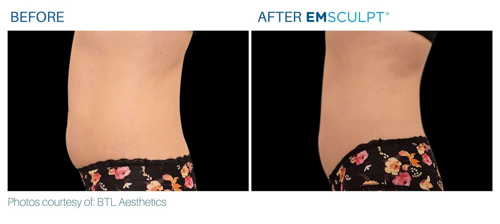 EMSCULPT BEFORE AND AFTER, REAL PATIENT RESULTS