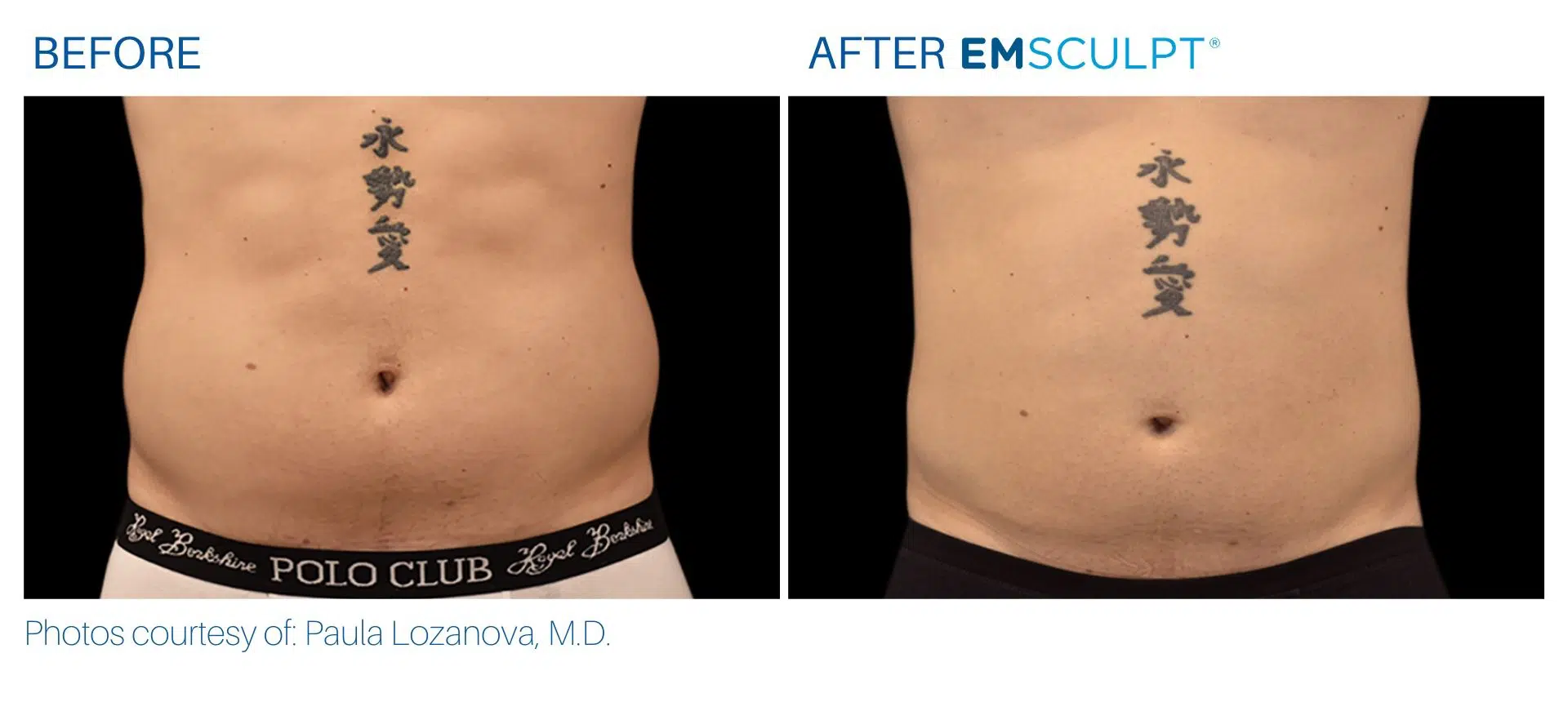 Emsculpt before and after images Body Morph MD