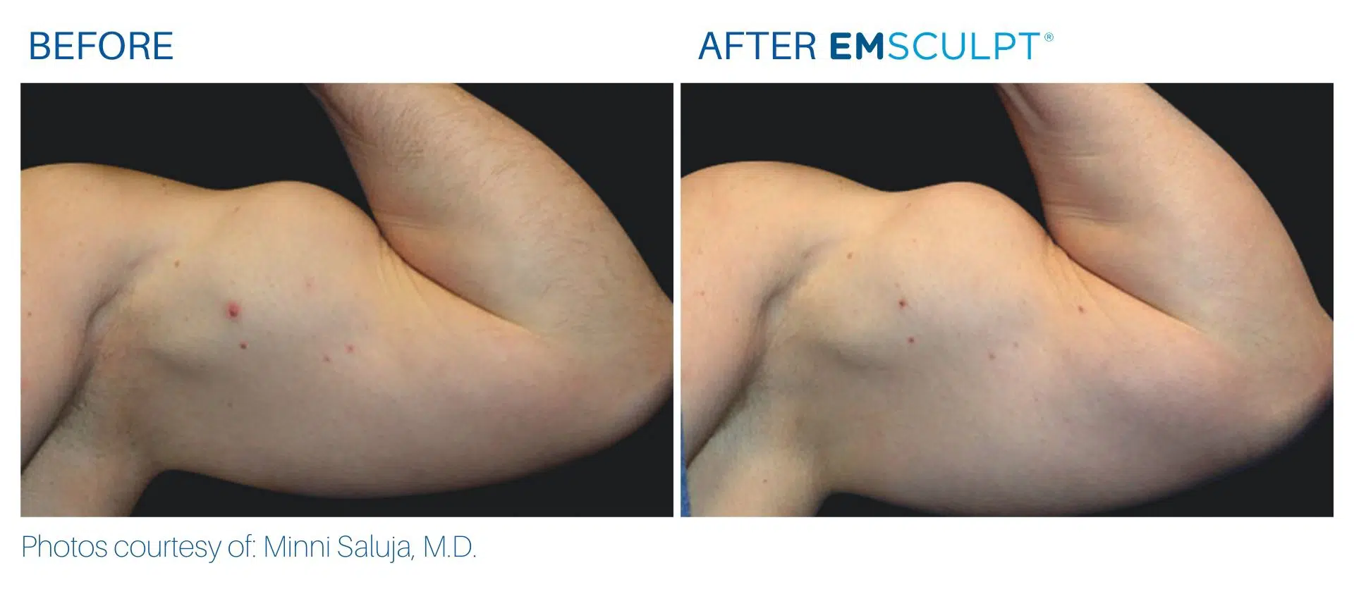 Emsculpt provider in the Yonkers Body Morph MD
