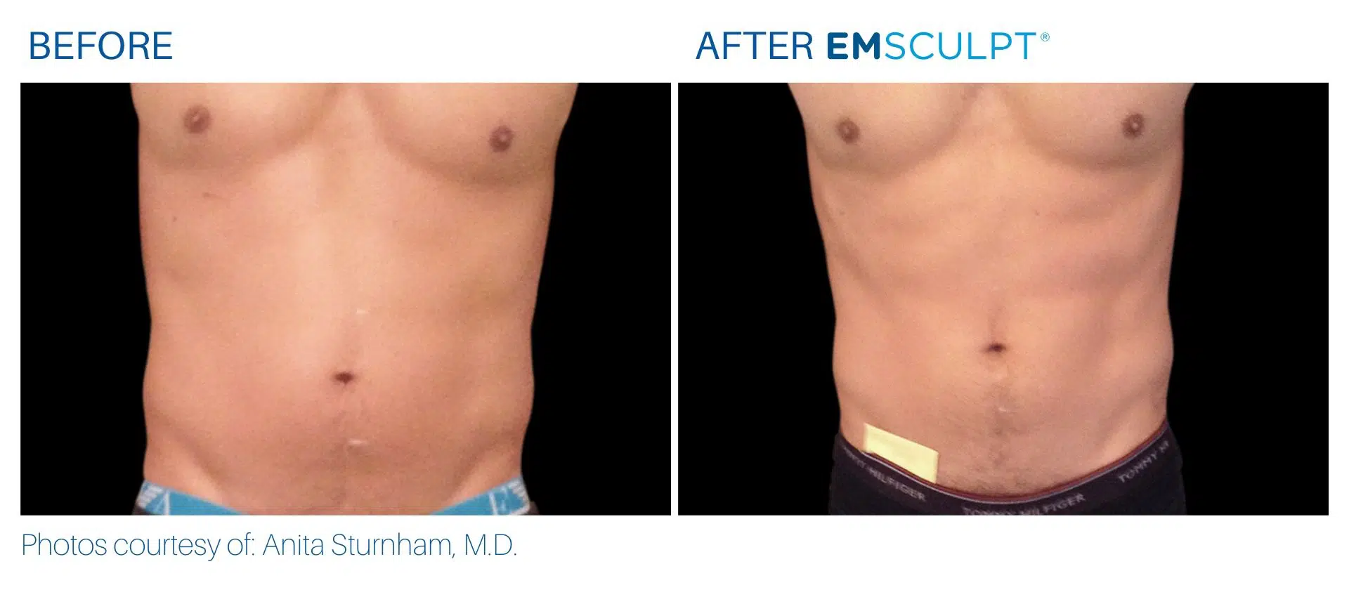 Emsculpt in Yonkers Body Morph MD before and after images