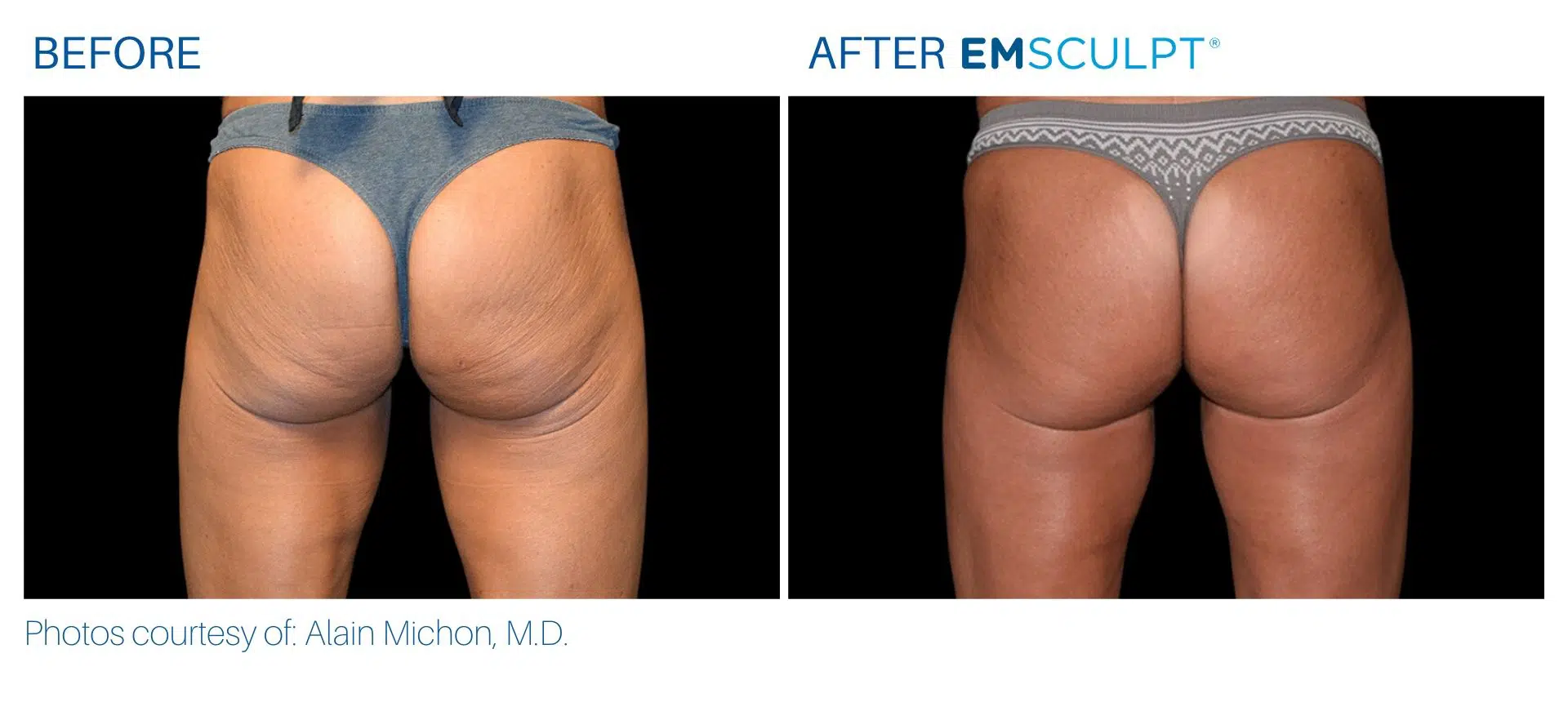 Emsculpt in Yonkers before and after images