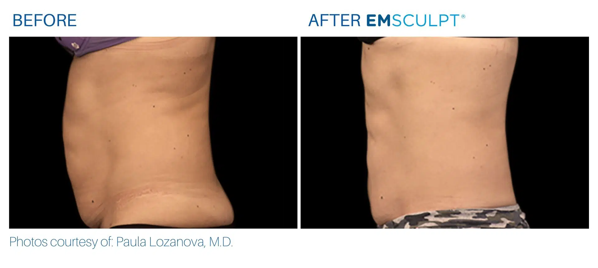 Emsculpt before and after images Yonkers, NY