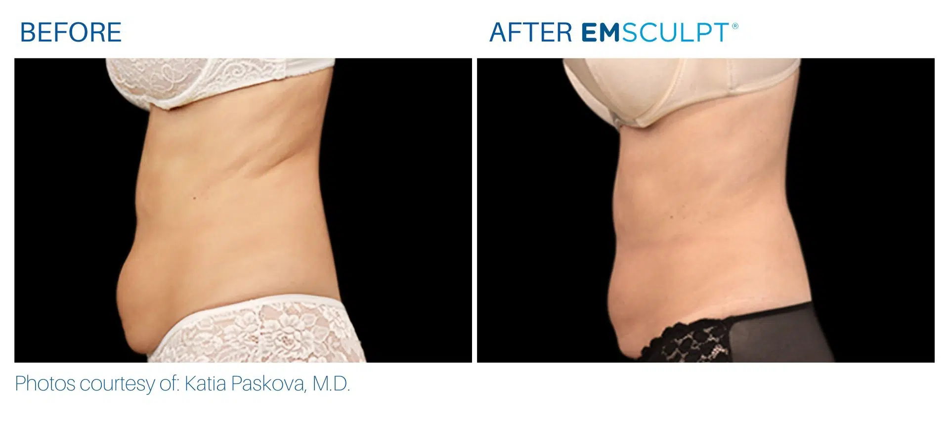 Emsculpt Before and After Real Patient Results Body Morph MD