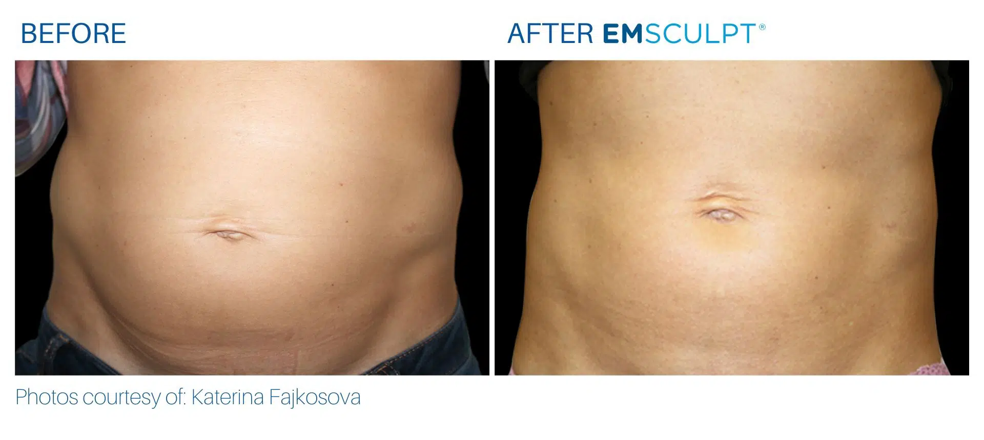 Emsculpt before and after female abdomen treatment Yonkers, NY
