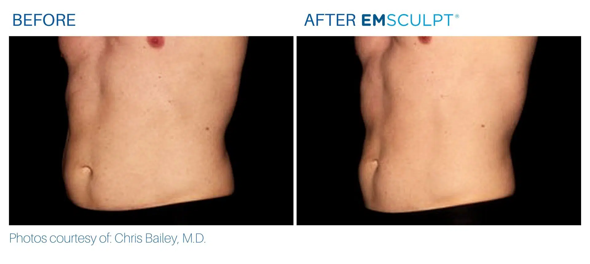 Emsculpt before and after male abdomen treatment Body Morph MD
