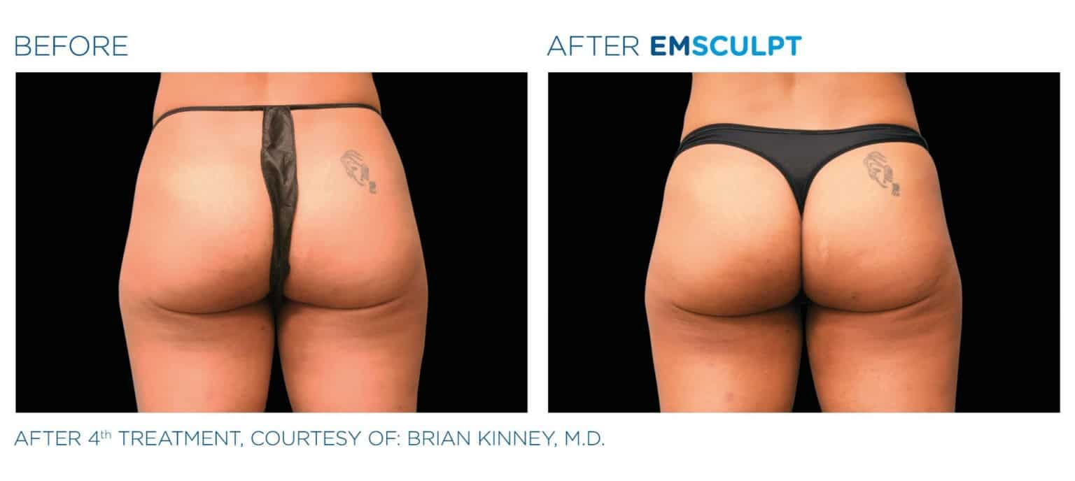 emsculpt_yonkers_before_and_after_
