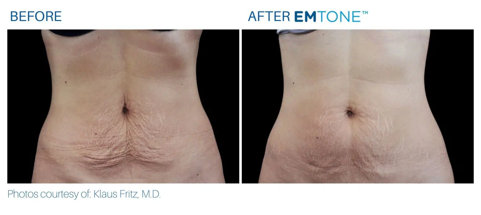 emtone_before_and_after_bodymorphmd