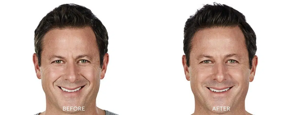 Before and after photos of a man showing tighter and smoother skin from Juvederm in Naples, FL.