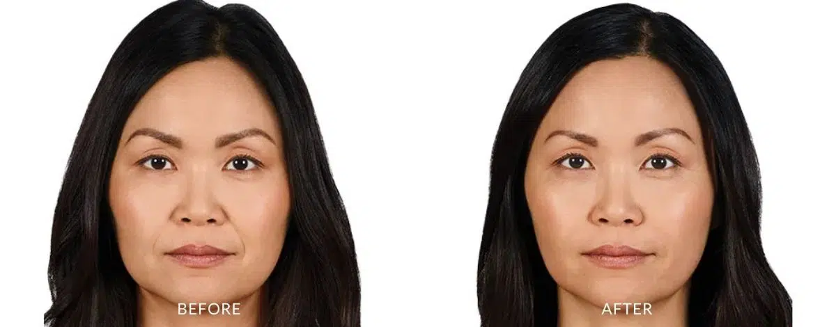 Before and after photos of a woman showing reduced wrinkles from Juverderm in Naples, FL.