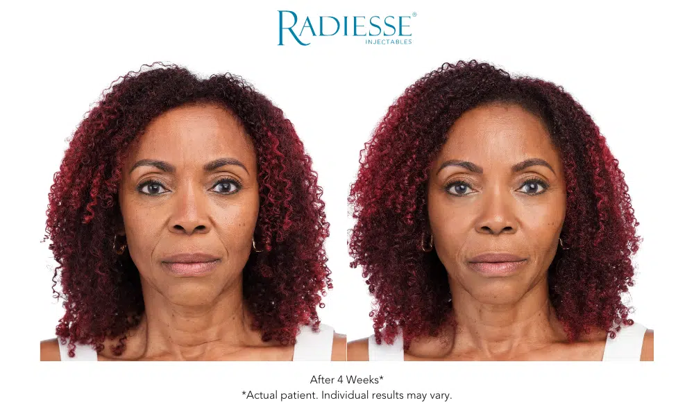 Radiesse Before and After1