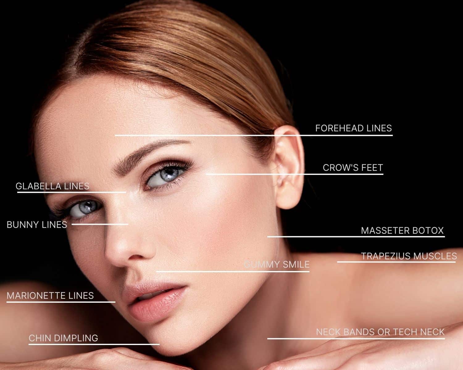 An image of a woman showing the treatment areas of a Botox injection in Naples, FL