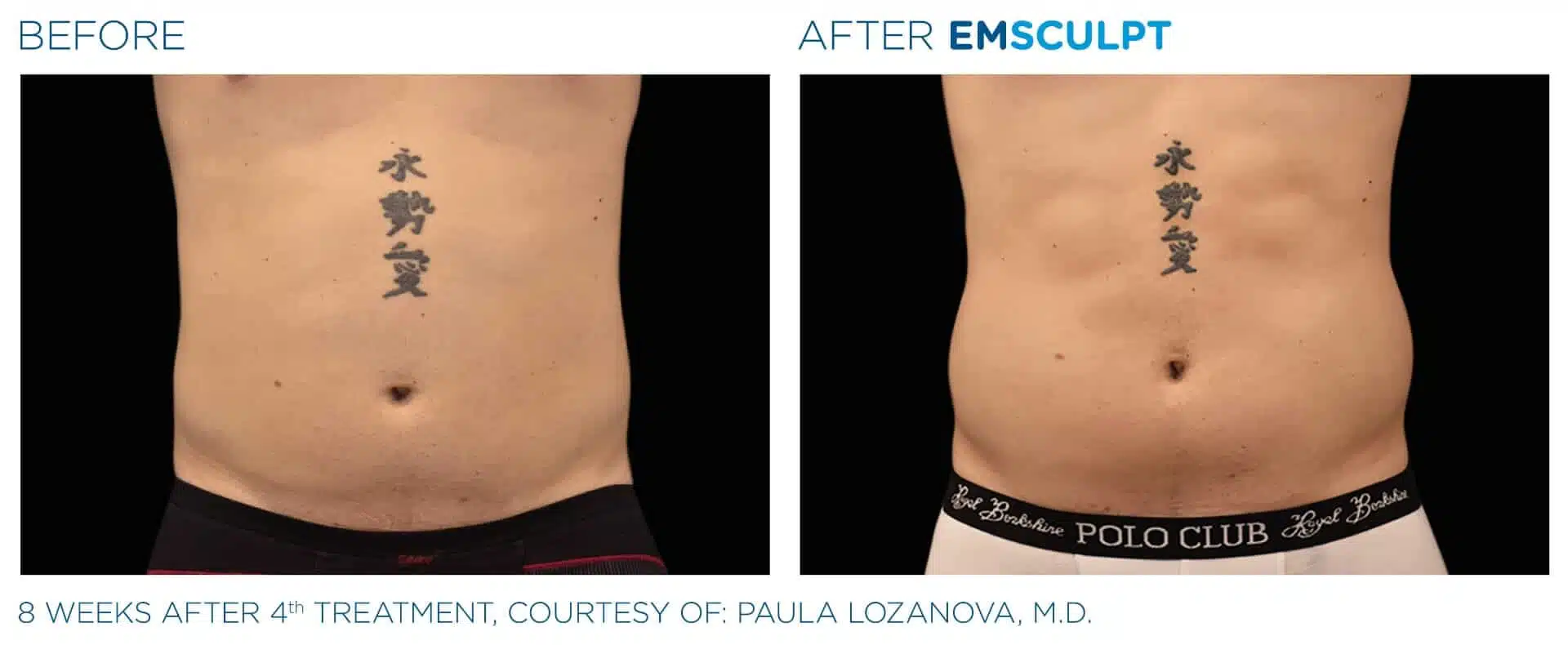Emsculpt abdomen before and after results.